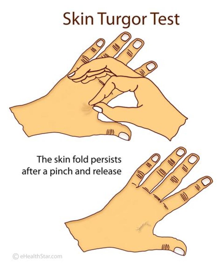 Question: Is Decreased Skin Turger The Same As Tented Skin